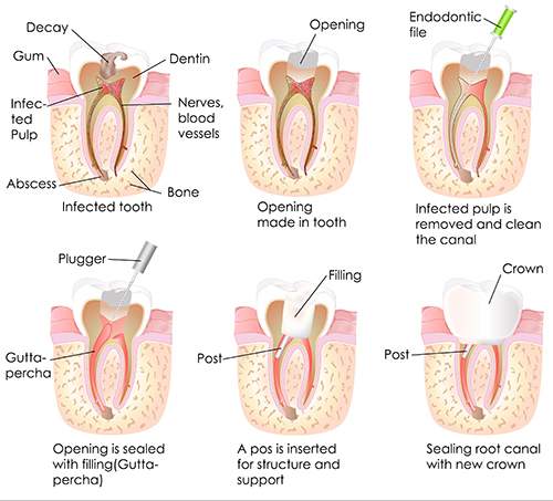 Root Canal Therapy in Hanover Park, IL